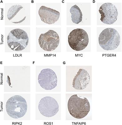 Identification and Development of Inflammatory Response–Related Genes Signature Associated With Prognosis Evaluation and Immune Status of Bladder Cancer